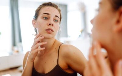 Jak zlikwidować blizny po trądziku domowymi sposobami?