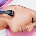 Dermaroller czy dermapen co lepiej sprawdzi się w domowej pielęgnacji?
