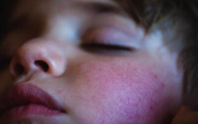 Jak rozpoznać objawy trądziku różowatego?