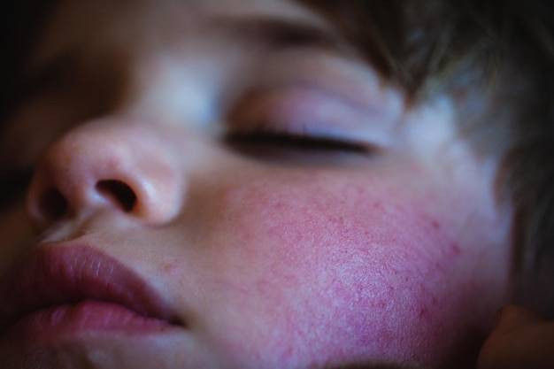 Jak rozpoznać objawy trądziku różowatego?