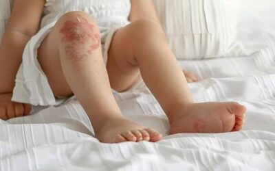 Co na skórę atopową sprawdza się na co dzień?