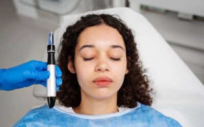 Dermapen ze znieczuleniem czy bez co wybrać podczas zabiegu?