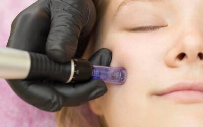 Mezoterapia igłowa w domu jak często można ją wykonywać?