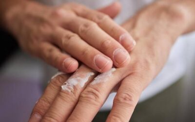 Popękane dłonie jak leczyć domowymi sposobami?