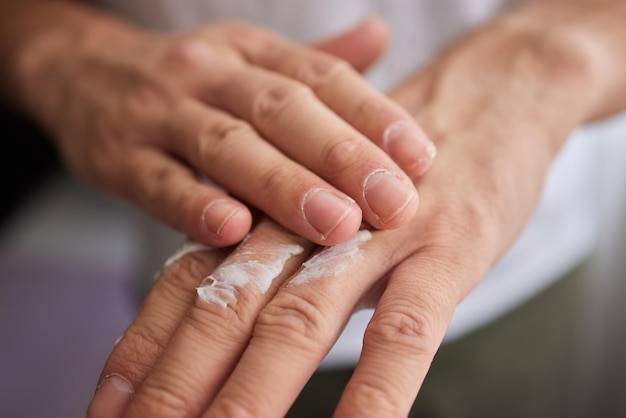 Popękane dłonie jak leczyć domowymi sposobami?