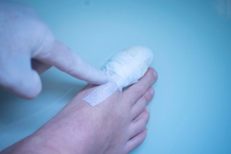 Buty po operacji na haluksa – jak nie zaszkodzić procesowi gojenia?