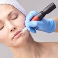 Dermapen czy laser na blizny co wybrać dla siebie?