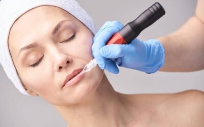 Dermapen czy laser na blizny co wybrać dla siebie?