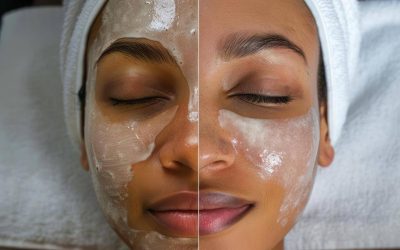 Czy po kwasach można robić peeling?
